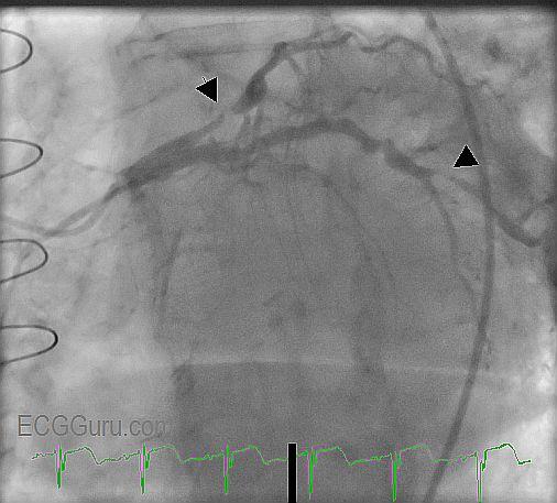 Coronary artery disease | ECG Guru - Instructor Resources